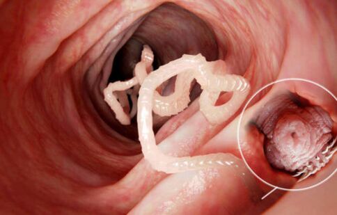 червь паразит в организме человека